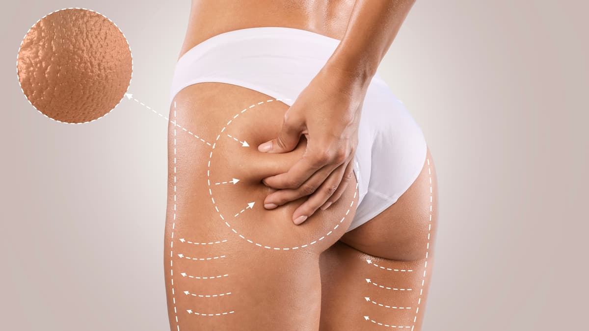 TRAITEMENT ANTI-CELLULITE